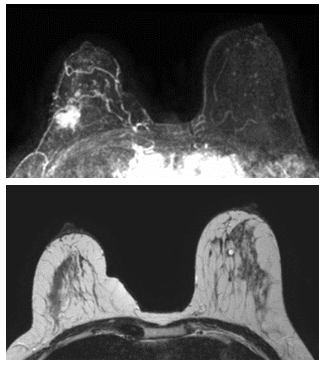 МРТ молочних залоз / МРТ імплантів молочних залоз