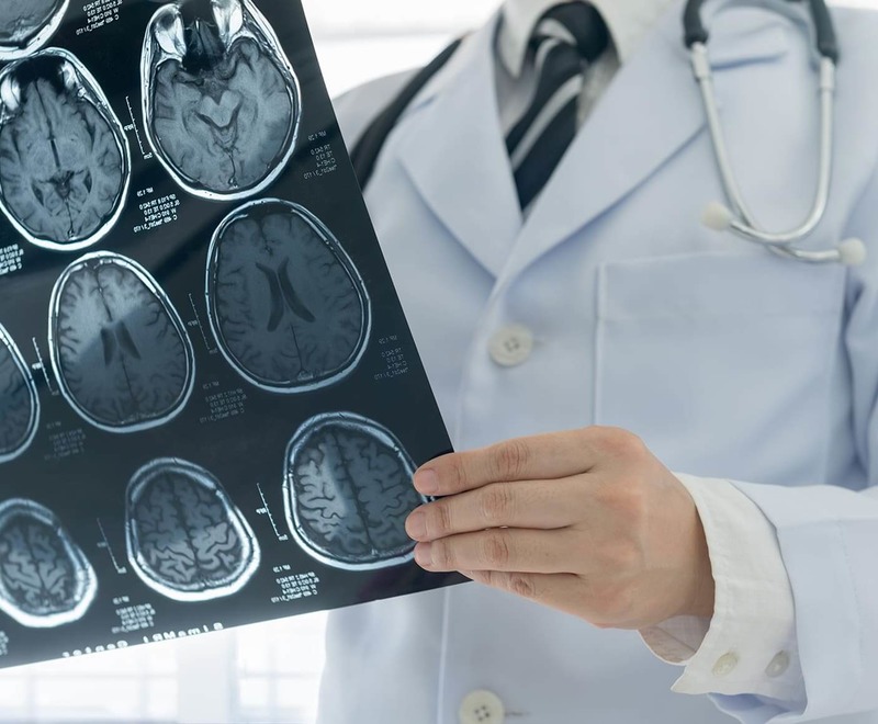 Гліома головного мозку