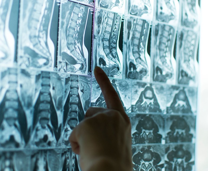 Спондильоз